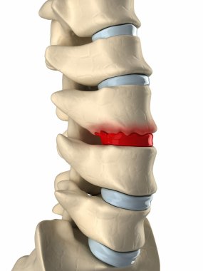 disk degenarated tarafından osteophyte oluşumu