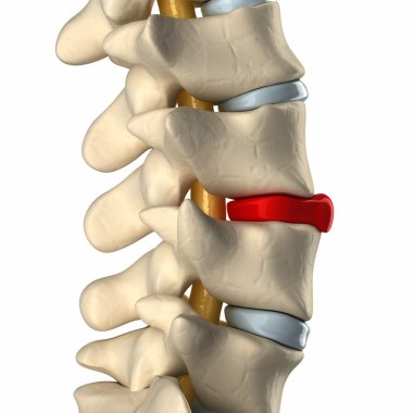 yanal görünümünde rüptüre disk
