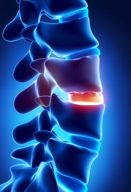 x-ışını osteophyte oluşumu ile disk degenarated