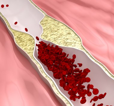 Atherosclerosis disease - plague blocking blood flow clipart