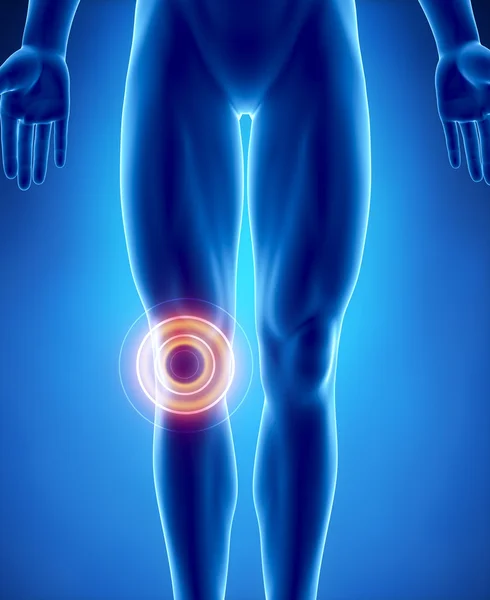 Human knee problem with highlighted area — Stock Photo, Image