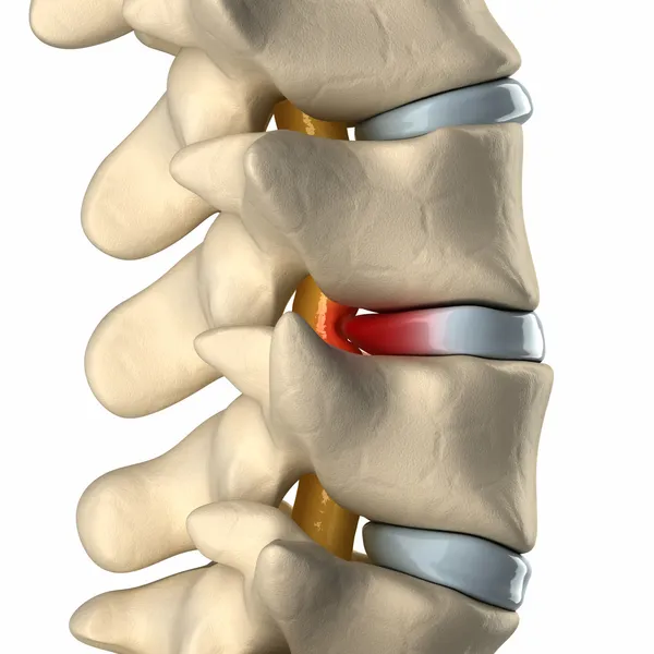 脊髓的椎间盘膨出的压力下 — 图库照片