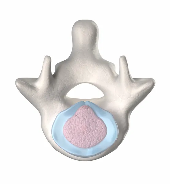 Intervertebral disk dejenerasyonu - prolapsusu - evre 3-5 — Stok fotoğraf