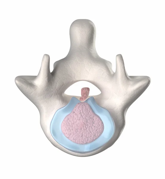 Intervertebral disk dejenerasyonu - haciz - stage 4-5 — Stok fotoğraf