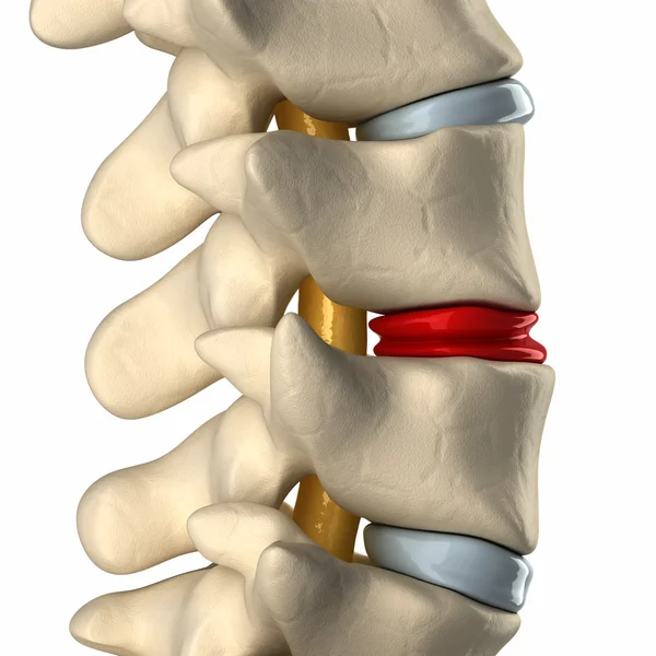 Disco degenerado na coluna vertebral — Fotografia de Stock