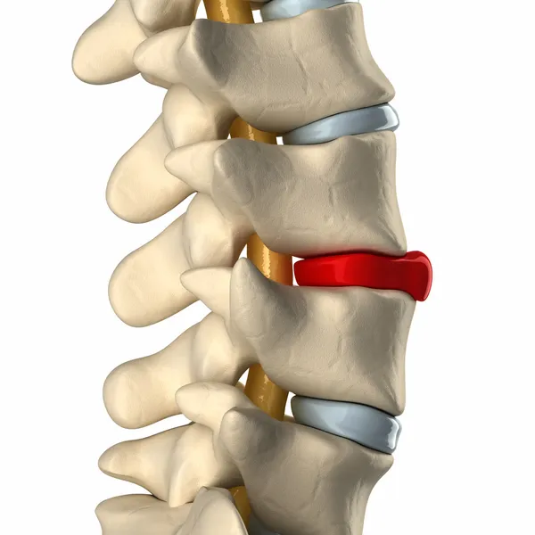 yanal görünümünde rüptüre disk