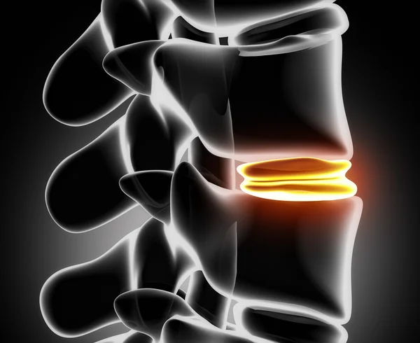 Gedegenereerd schijf volgens x-ray - close-up — Stockfoto