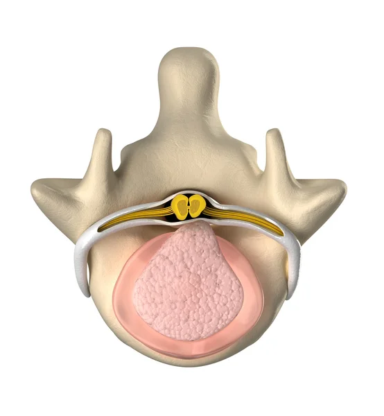 Intervertebral skivan med trycket på ryggmärgen ovanifrån — Stockfoto