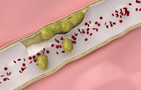 Koroner kolesterol dolaşım sistemi seyahat eder. — Stok fotoğraf