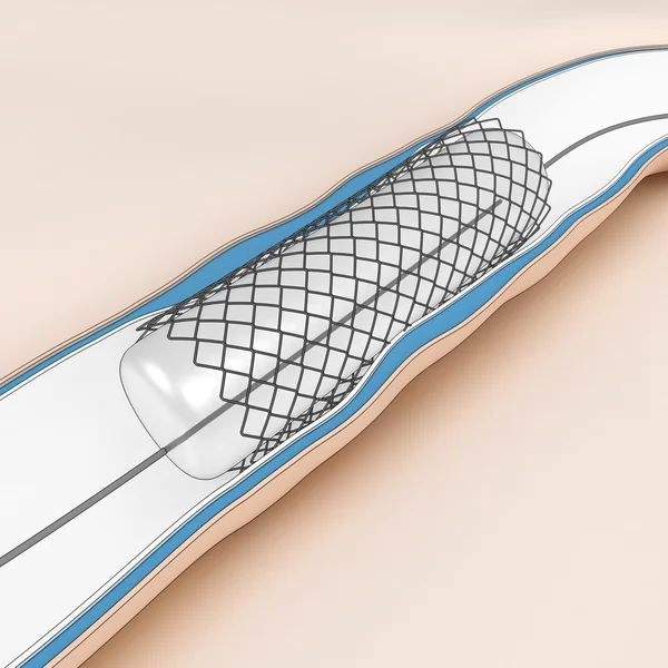 Procedimiento de angioplastia coronaria: balón con arteria lumínica de apertura de stent — Foto de Stock