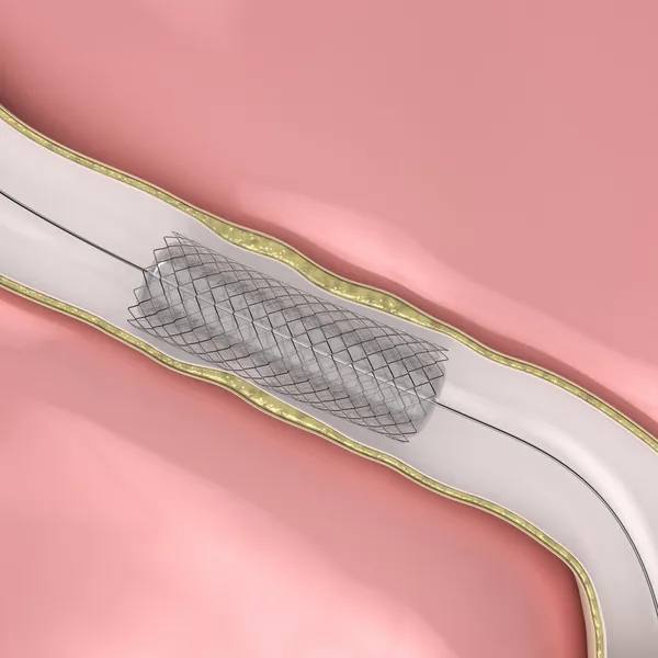 Procedimiento de angioplastia coronaria: balón con arteria lumínica de apertura de stent — Foto de Stock