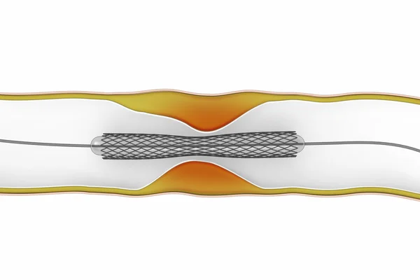 Procedimiento de angioplastia coronaria: plaga que bloquea el flujo sanguíneo —  Fotos de Stock