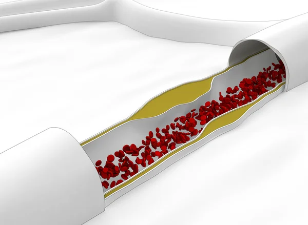 Формирование бляшки в артериальной стене — стоковое фото