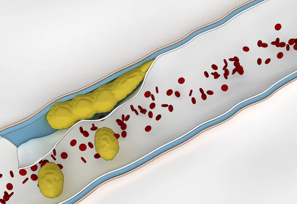 Powstawania płytki nazębnej w ścianie tętnic - podróży cholesterolu we krwi — Zdjęcie stockowe