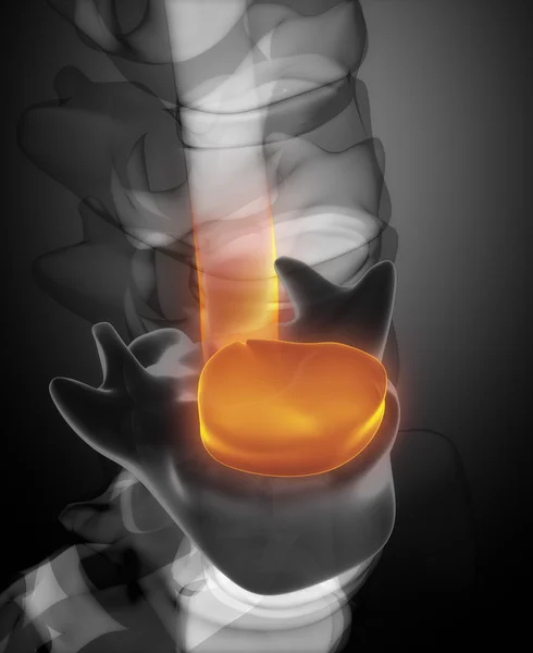 Disc herniation in x-ray view — Stock Image Disc herniation in x-ray view Royalty Free Stock Images