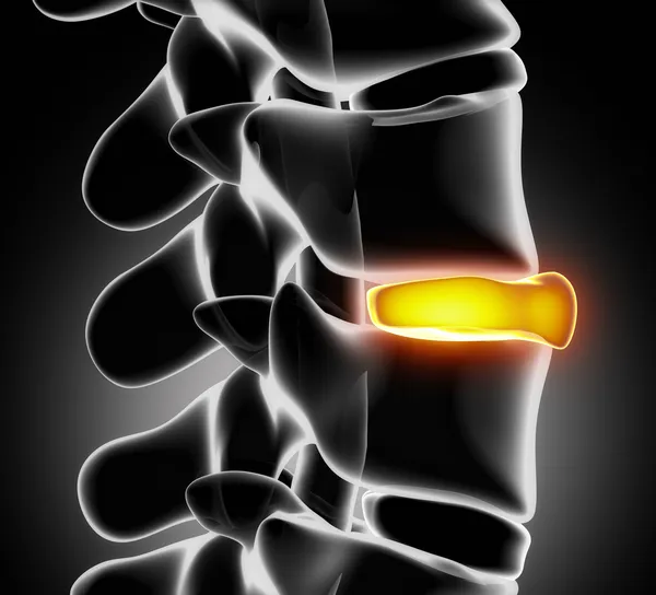 Disc ruptured in x-ray view - close up — Stock Image Disc ruptured in x-ray view - close up Stock Image