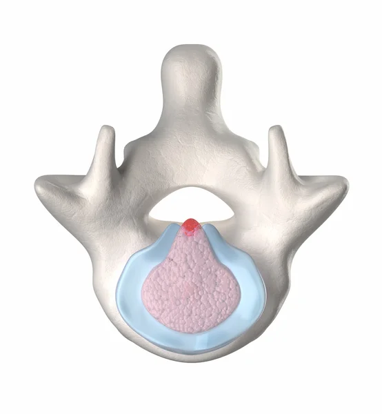 Intervertebral disc degeneration - EXTRUSION - stage 4-5 — Stock Image Intervertebral disc degeneration - EXTRUSION - stage 4-5 Stock Photo