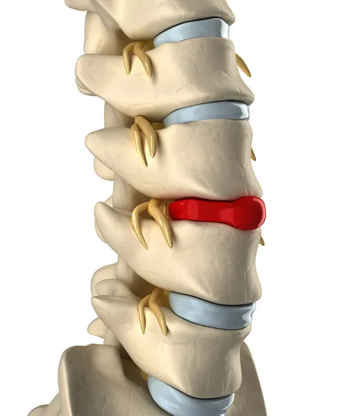 Disc ruptured with veretebras — Stock Image Disc ruptured with veretebras Stock Picture