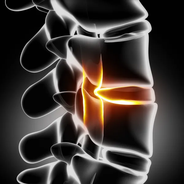 Herniated disc with pressure on spinal cord close-up — Stock Image Herniated disc with pressure on spinal cord close-up Stock Photo