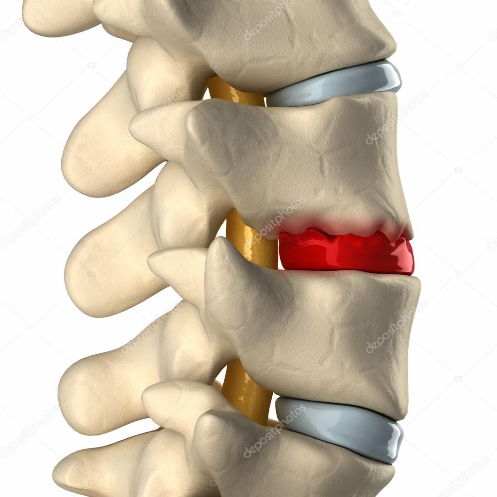 Disc degeneration by osteophyte formation lateral view — Stock Photo