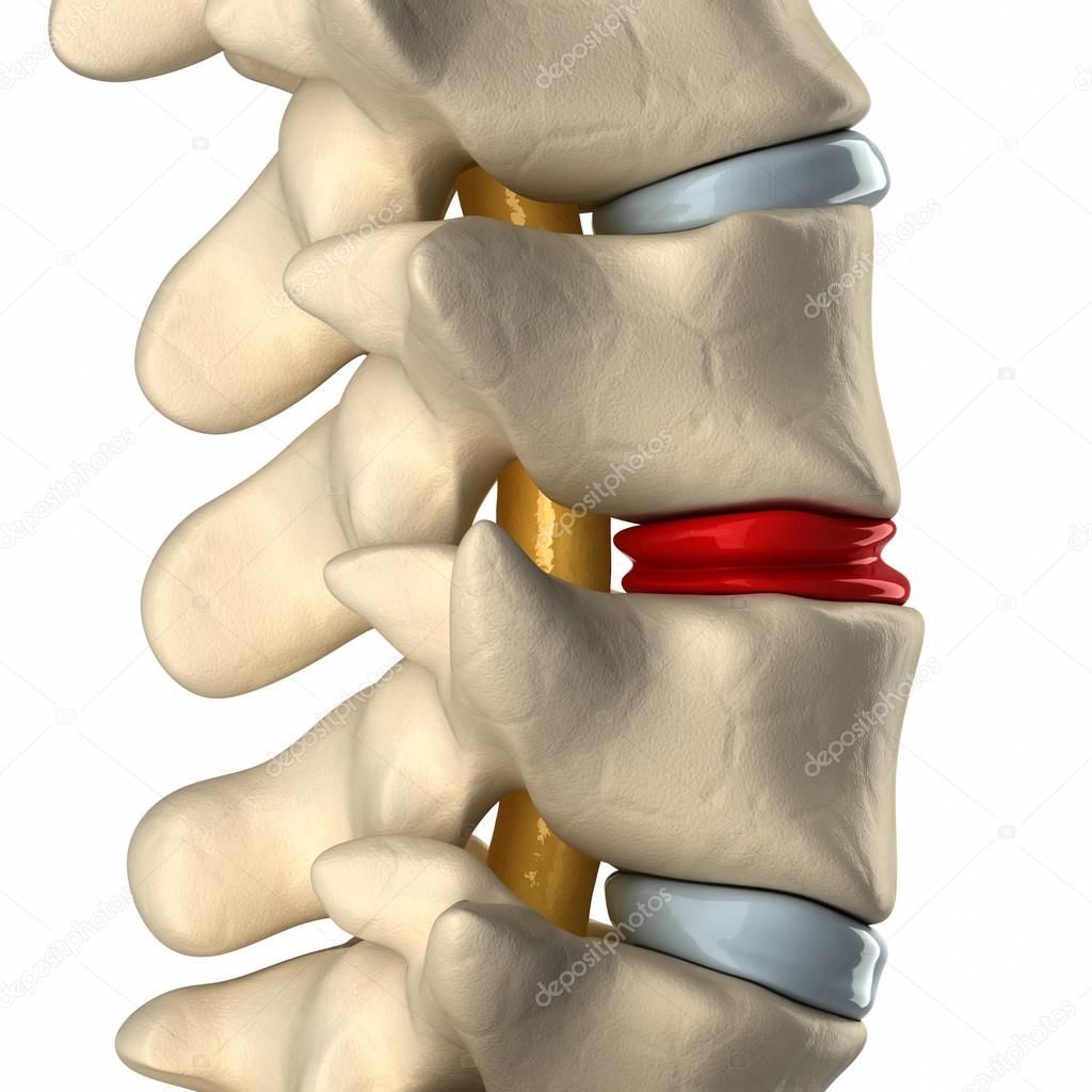 Degenerated disc in spine
