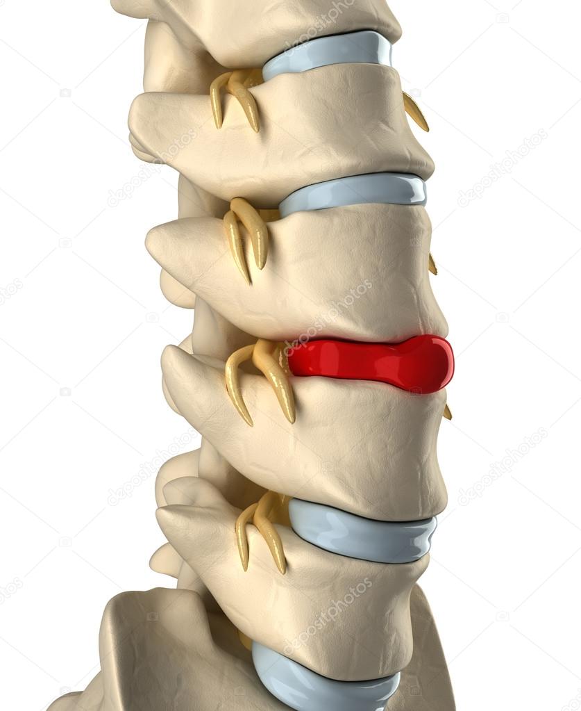 Disc ruptured with veretebras