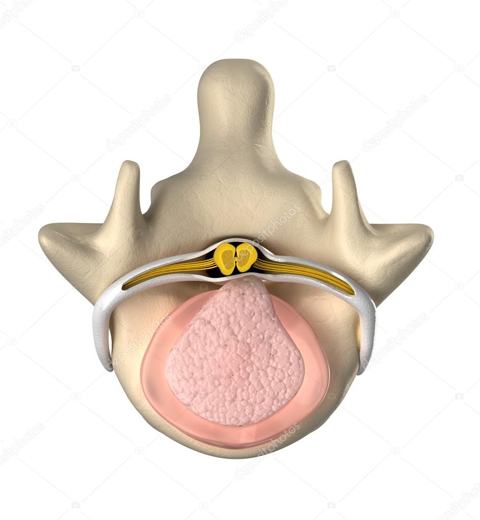 Intervertebral disc with pressure on spinal cord top view