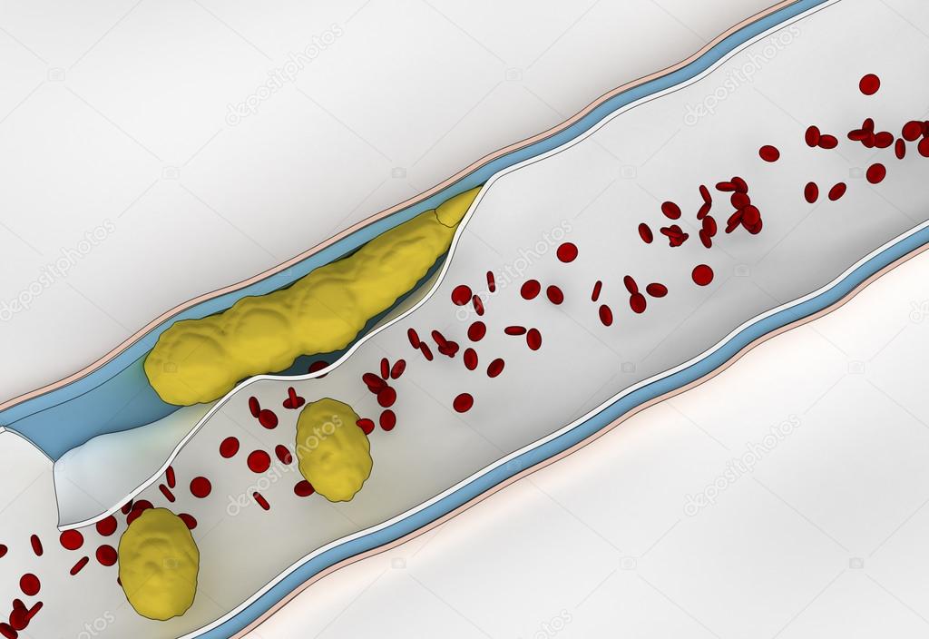 Formation of Plaque in the Arterial Wall - cholesterol travel in blood