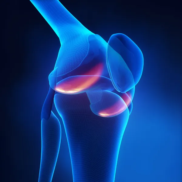 Knie-Arthritis — Stockfoto