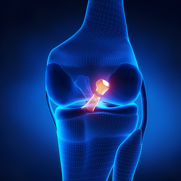 Torn Posterior Cruciate Ligament