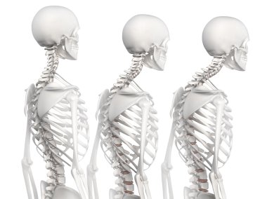 Kyphotic spine in 3 phases clipart