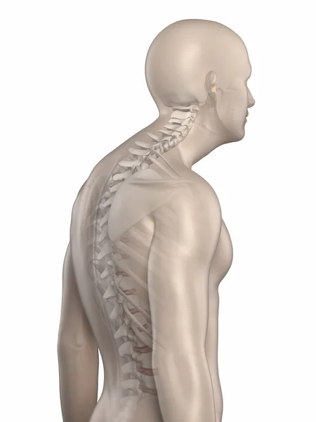 Kyphotic spine — Stockfoto