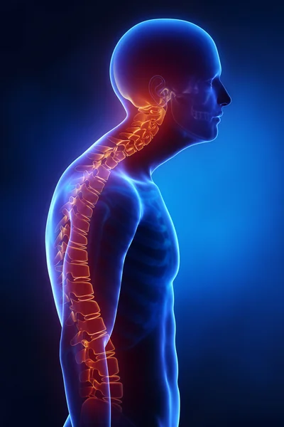 Kyphotic spine lateral view in x-ray — Stock Photo, Image