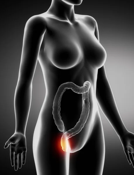 HEMORRHOIDS femminile concetto vista laterale a raggi X — Foto Stock