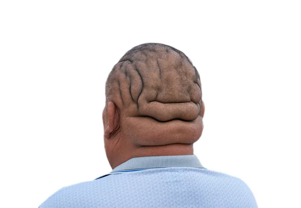 Thick bald head with folds. Wrinkles on a bald head due to excess weight
