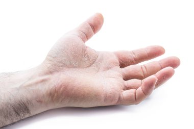 Beyaz arka planda izole edilmiş deri hastalıklarını gösteren erkek eli görüntüsü 