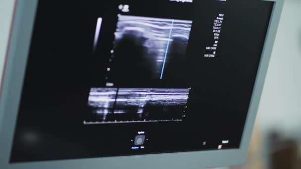 Modern Echocardiography Machine Screen Showing Ultrasound Boys Heart Close Shot — Stock Video