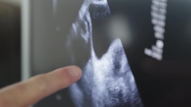 Zbliżenie Ekranu Nowoczesnej Ultradźwiękowej Maszyny Szpitalu Podczas Gdy Młodzi Chłopcy — Wideo stockowe