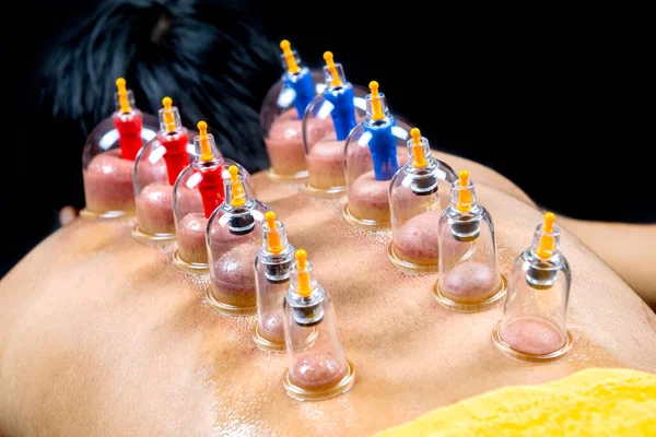 Man Met Cupping Behandeling Rug Met Zwarte Achtergrond — Stockfoto