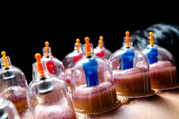 Man Cupping Treatment Back Black Background — Stock Photo, Image