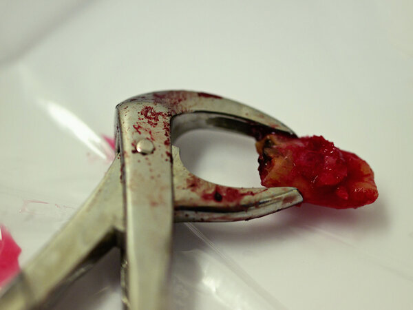 Extracted tooth with forcep
