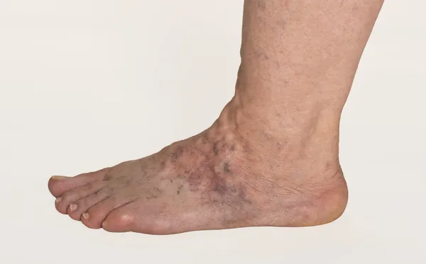 Varicose Veins — Stock Photo, Image