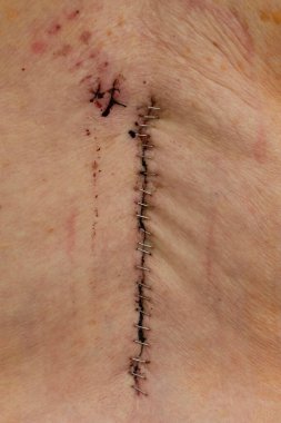 L3-L4-L5 omurga füzyonundan sonra Staples)