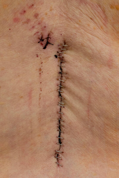 Скобы после операции на спине на L3 - L4 - L5 (спинной синтез)