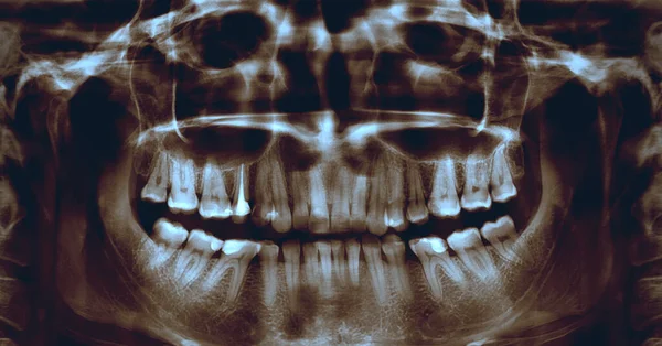 Imagen Panorámica Rayos Dientes Humanos Fosilizados Imagen Digital Composición Interna — Foto de Stock