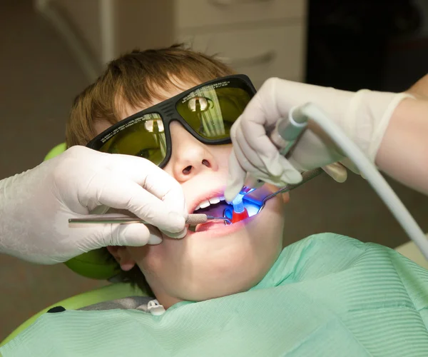 Endurecimento do enchimento dentário — Fotografia de Stock