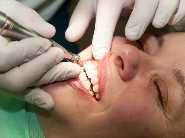 Отделка стоматологического заполнения — стоковое фото