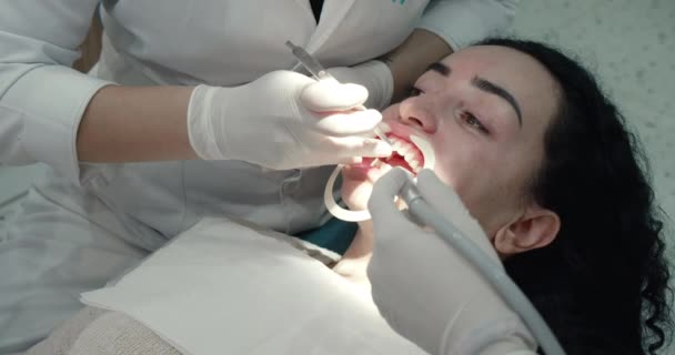 O dentista aplica cola especial para fixar os aparelhos para endireitar os dentes. Odontologia. Close-up de dentes femininos está em processo de instalação de aparelho. Conceito de cuidados de saúde e medicina — Vídeo de Stock