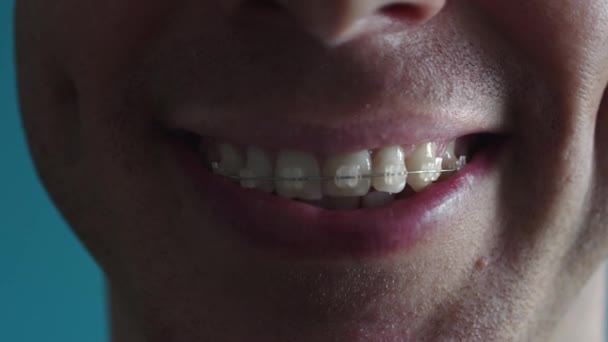Großaufnahme glücklicher Mann lächelt mit Zahnspange aus nächster Nähe. Schöner lächelnder Mann mit Zahnklammern. Lächelnder Mann. Zahnspange Mund — Stockvideo