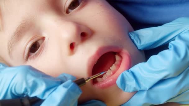 Dziecko Otwartymi Ustami Zbliżenie Dentysty Bliskie Dłonie Dentysty Który Robi — Wideo stockowe